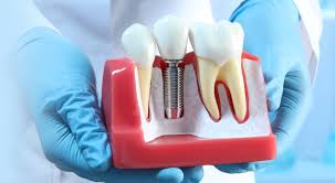 Dental Implants